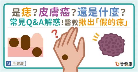 身體痣|是痣？皮膚癌？還是什麼？常見Q&A解惑！醫教揪出「。